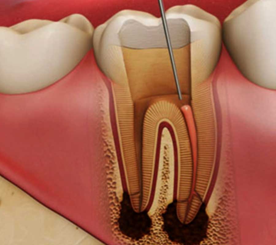 Root Canal Therapy at Elite Clinic: Best Dentist in Rohini, Delhi