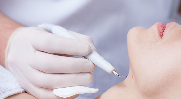 Radiofrequency Ablation: Elite Clinic Radiofrequency Ablation treatment at Elite Clinic: Best Dermatologist in Rohini, Delhi