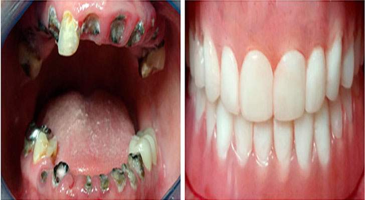 Immediate Dentures surgery at Elite Clinic: Best Dental Clinic in Rohini, Delhi