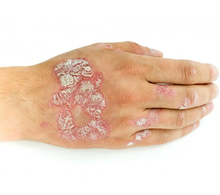 Psoriasis treatment at Elite Clinic: Best Skin Treatment in Rohini, Delhi