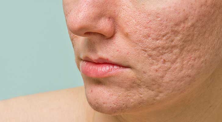 Scars: Elite Clinic Scars treatment at Elite Clinic: Skin Care Clinic in Rohini, Delhi