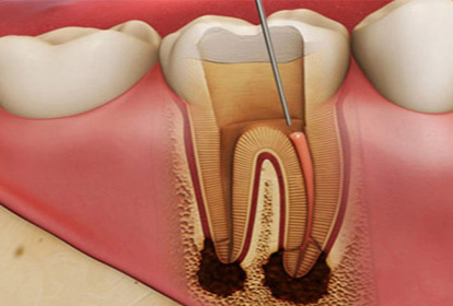 Root Canal Therapy Treatment at Elite Clinic: Dental Clinic in Rohini, Delhi