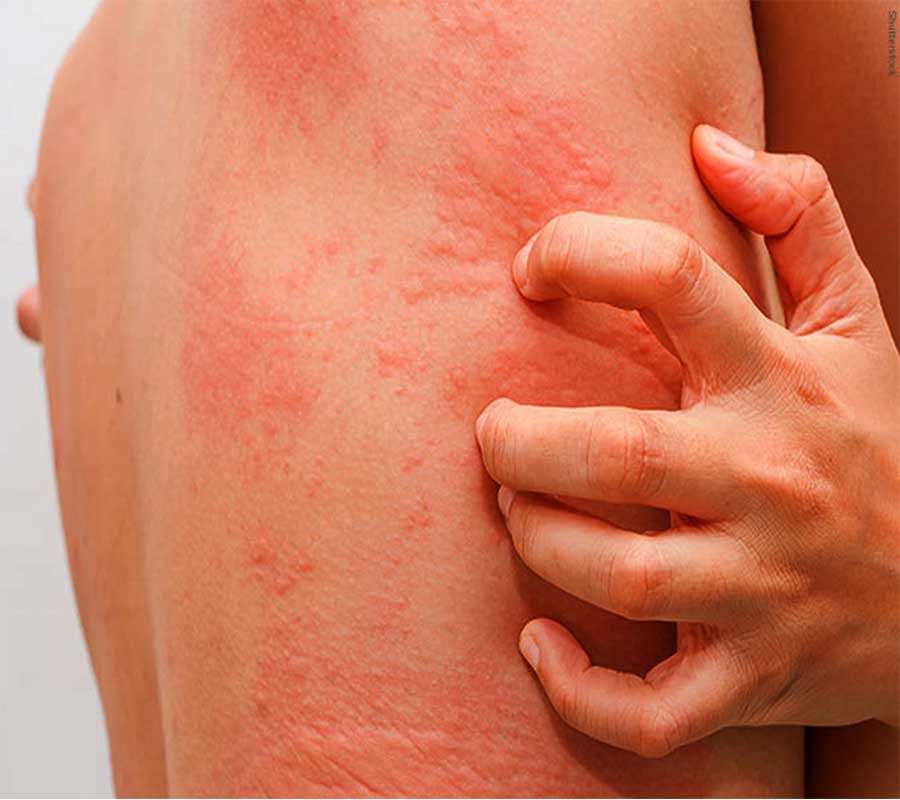 Urticaria treatment at Elite Clinic: Best Skin Treatment in Rohini, Delhi