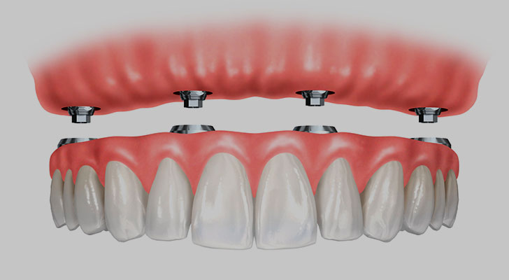 Implant Supported Over Denture at Elite Clinic: Dental Implant Clinic in Rohini, Delhi
