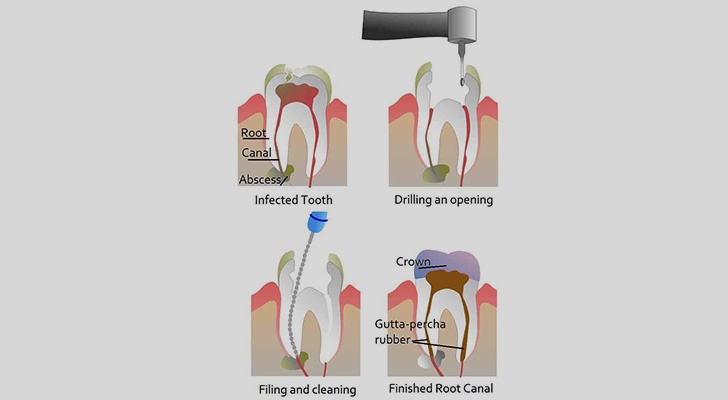 Single Sitting RCT at Elite Clinic: Best Dentist in Rohini, Delhi