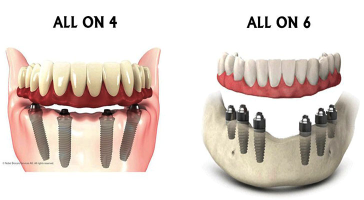 All-on-4-and-All-on-6 treatment in at Elite Clinic: Best Implant Dentist in Rohini, Delhi