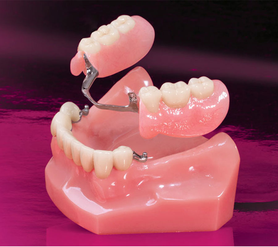 Crowns, Bridges & Dentures at Elite Clinic - Best Dental Clinic in Rohini, Delhi