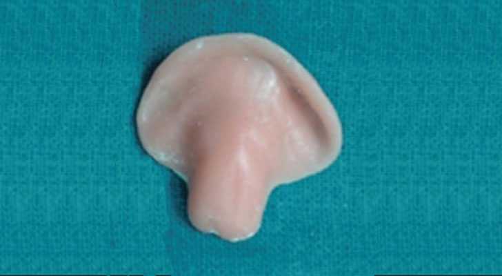 Cleft Palate: Elite Clinic Cleft Palate treatment at Elite Clinic: Dermatologist in Rohini, Delhi
