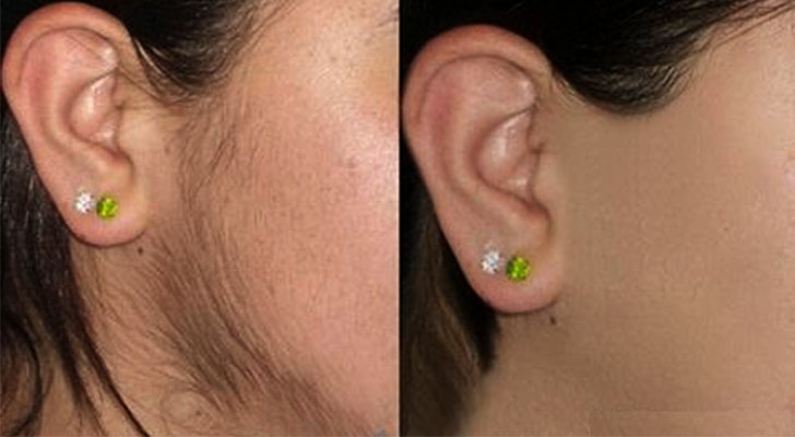 Unwanted Hairs: Elite Clinic Unwanted Hairs treatment at Elite Clinic: Skin Care Clinic in Rohini, Delhi