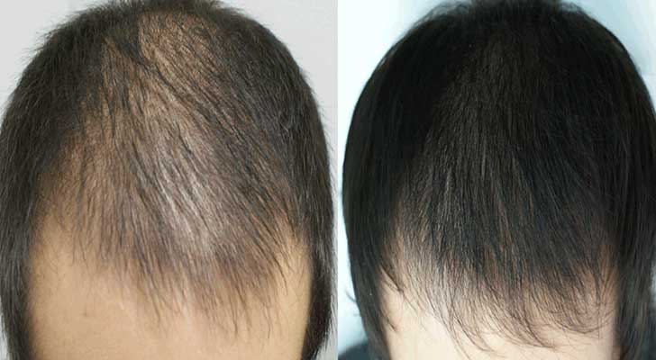 Hair Treatment in Delhi | Best Hair Specialist in Rohini, Delhi - Elite  Clinic
