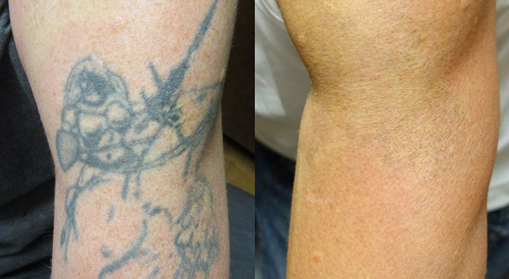 Tattoo Removal: Elite Clinic Tattoo Removal treatment at Elite Clinic: Skin Care Clinic in Rohini, Delhi