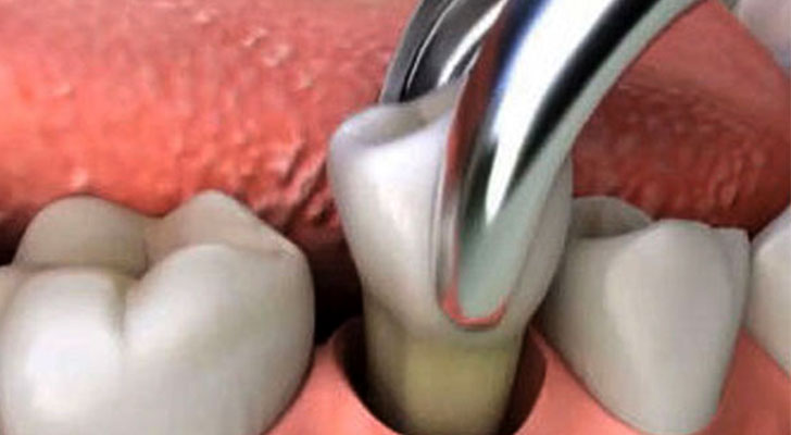 Tooth Extractions treatment at Elite Clinic: Best Dental Clinic in Rohini, Delhi