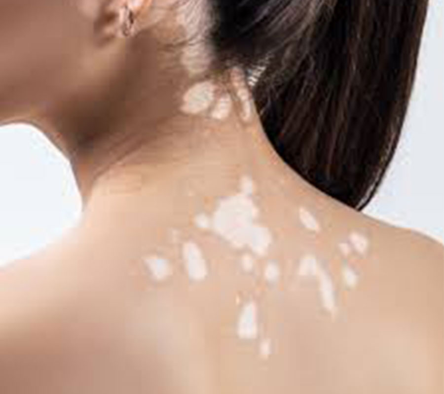 Vitiligo treatment at Elite Clinic: Best Skin Treatment in Rohini, Delhi