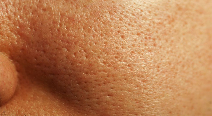 Open Pores: Elite Clinic Open Pores treatment at Elite Clinic: Skin Care Clinic in Rohini, Delhi