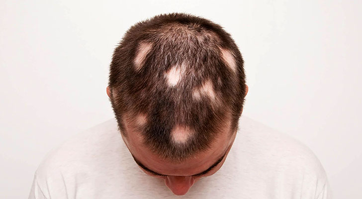 Alopecia Areata treatment at Elite Clinic: Best Hair Treatment in Rohini, Delhi