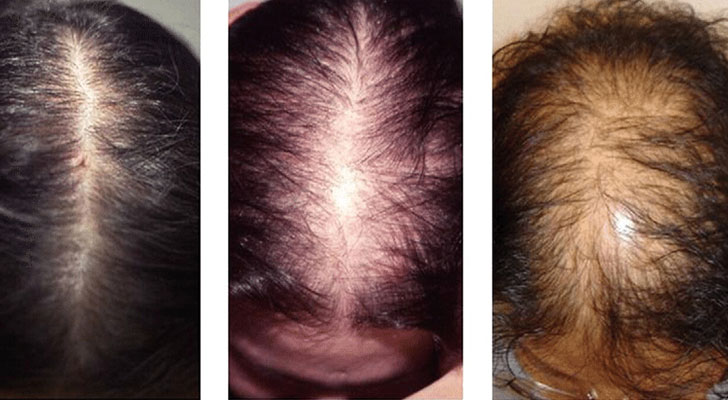 Androgenic Alopecia For Women treatment at Elite Clinic: Best Hair Treatment in Rohini, Delhi