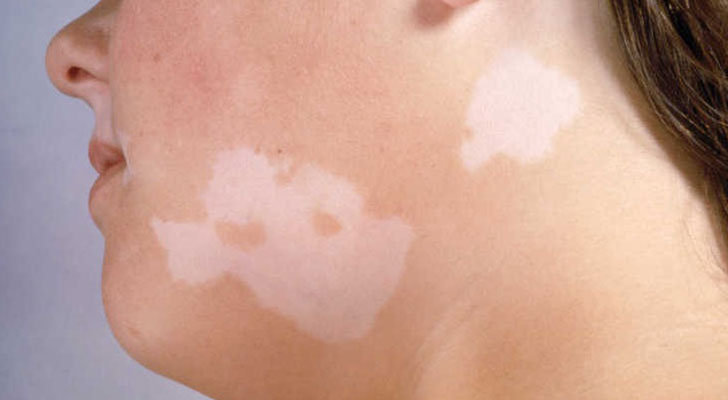 Vitiligo Surgery treatment at Elite Clinic: Best Dermatologist in Rohini, Delhi