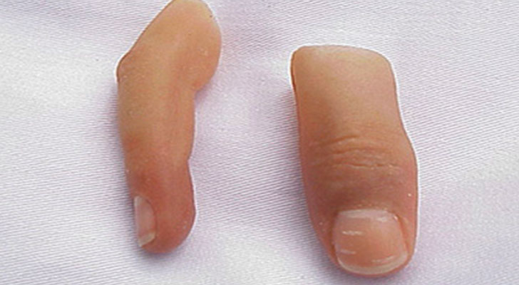 Artificial Finger Artificial Finger surgery at Elite Clinic: Best Dermatologist in Rohini, Delhi