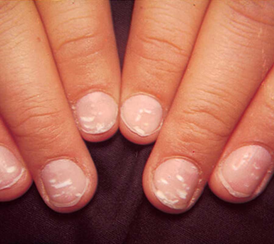 Nail Diseases treatment at Elite Clinic: Best Skin Treatment in Rohini, Delhi