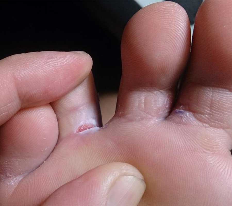 Fungal Infections treatment at Elite Clinic: Best Skin Treatment in Rohini, Delhi