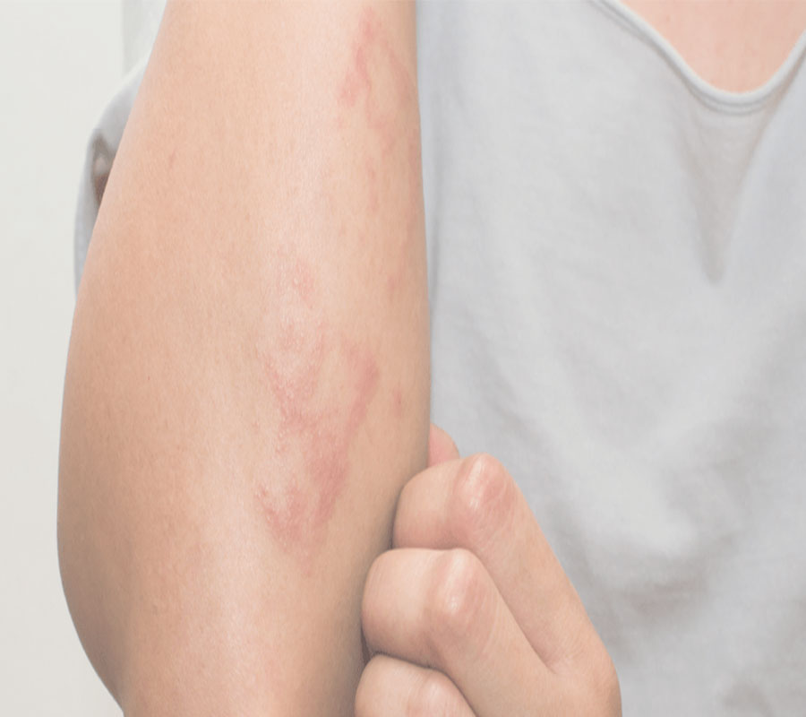 Eczema treatment at Elite Clinic: Best Skin Treatment in Rohini, Delhi
