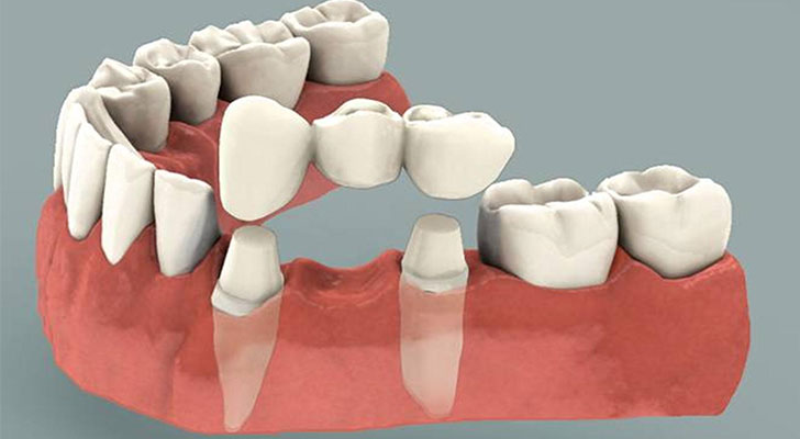 Dental Bridge treatment at Elite Clinic: Best Dental Clinic in Rohini, Delhi