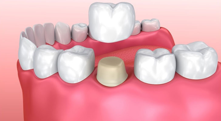 Dental Crown surgery at Elite Clinic: Dental Clinic in Rohini, Delhi
