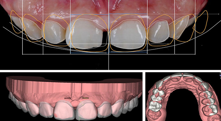 Digital Smile Designing at Elite Clinic: Teeth Whitening in Rohini | Teeth Whitening in Delhi