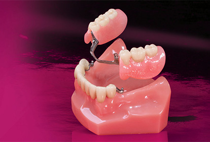 Crowns Bridges and Dentures Surgery at Elite Clinic: Best Dental Clinic in Rohini, Delhi