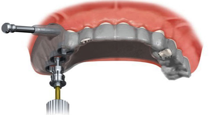Get Guided Implant Surgery at Elite Clinic: Dental Implant in Rohini,Delhi