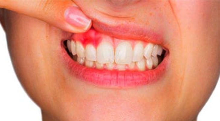 Gum Contouring treatment at Elite Clinic: Best Dental Clinic in Rohini, Delhi