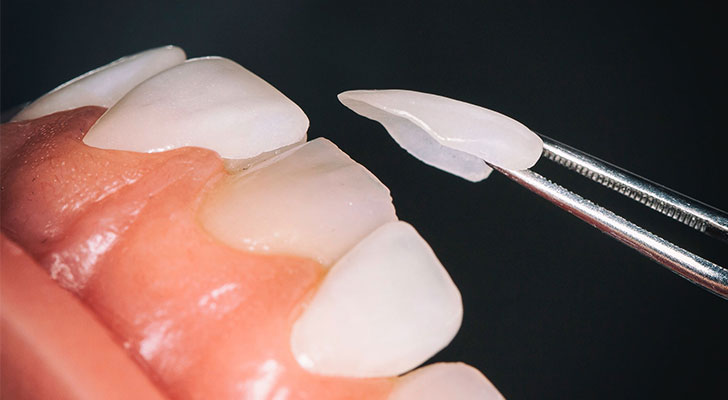 Laminate Veneers treatment at Elite Clinic: Teeth Whitening in Rohini | Teeth Whitening in Delhi