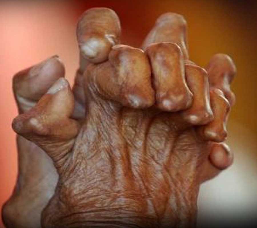 Leprosy treatment at Elite Clinic: Best Skin Treatment in Rohini, Delhi
