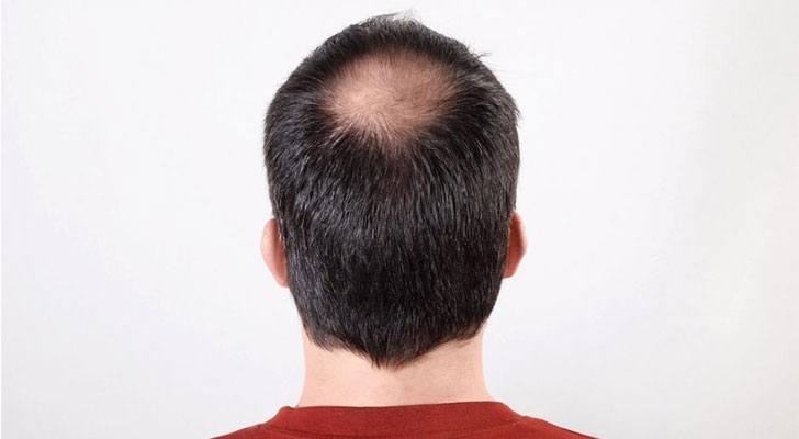 Androgenic Alopecia For Men treatment at Elite Clinic: Best Hair Treatment in Rohini, Delhi