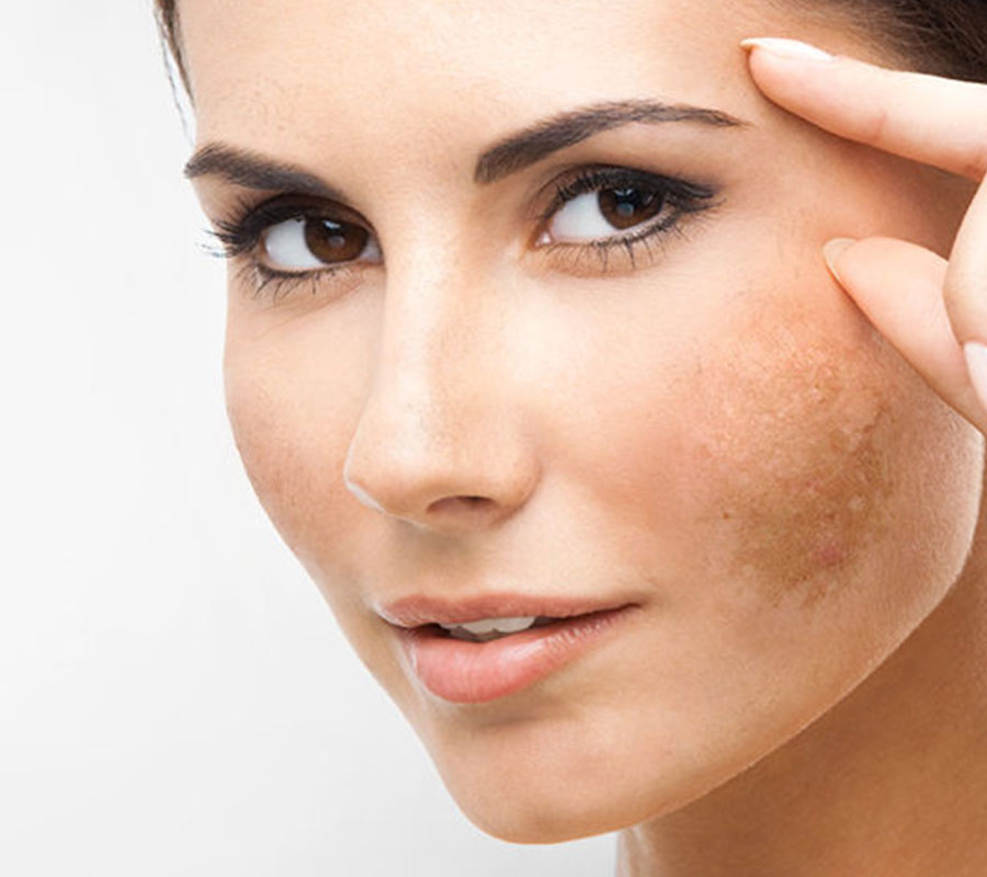 Melasma treatment at Elite Clinic