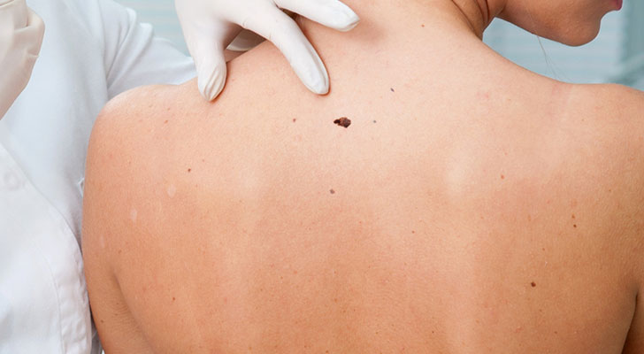 Mole & Wart Removal: Elite Clinic Mole & Wart Removal treatment at Elite Clinic: Skin Care Clinic in Rohini, Delhi