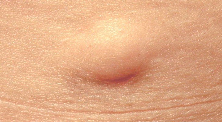 NHET For Sebaceous Cyst, Lipoma & Moles: Elite Clinic NHET For Sebaceous Cyst, Lipoma & Moles treatment at Elite Clinic: Best Dermatologist in Rohini, Delhi