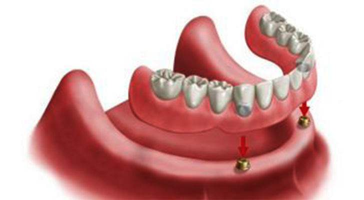 Over Dentures treatment at Elite Clinic: Dental Clinic in Rohini, Delhi