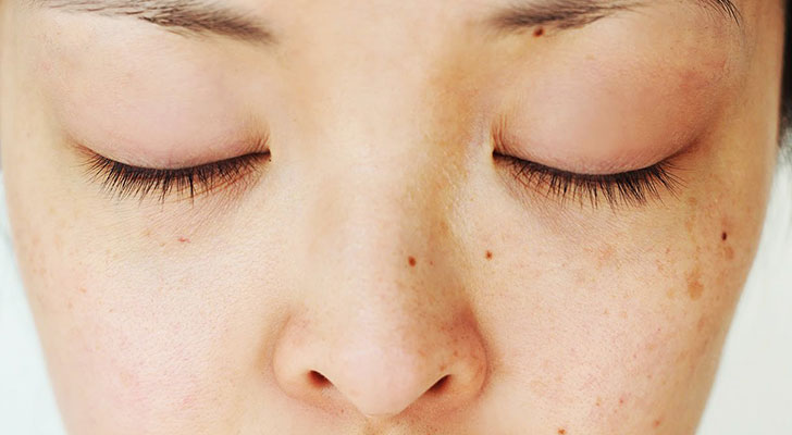Pigmentation & Blemishes: Elite Clinic Pigmentation & Blemishes treatment at Elite Clinic: Skin Care Clinic in Rohini, Delhi