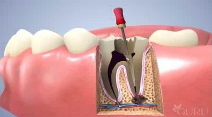 Root Canal Treatment at Elite Clinic: Best Dentist in Rohini, Delhi
