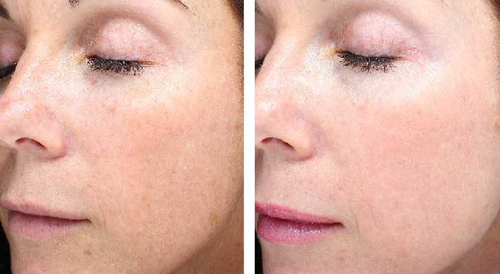 Skin Resurfacing treatment at Elite Clinic: Skin Clinic in Rohini, Delhi