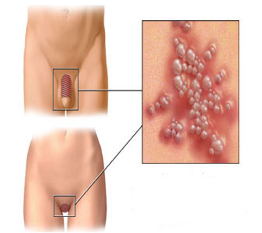 STDs treatment at Elite Clinic