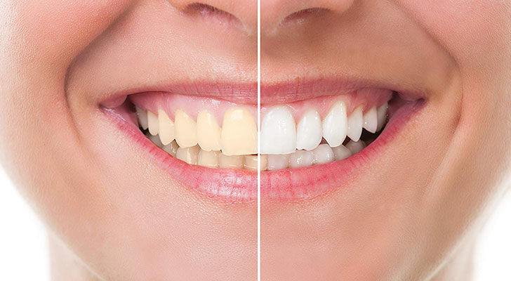 Teeth Whitening treatment at Elite Clinic: Teeth Whitening in Rohini | Teeth Whitening in Delhi