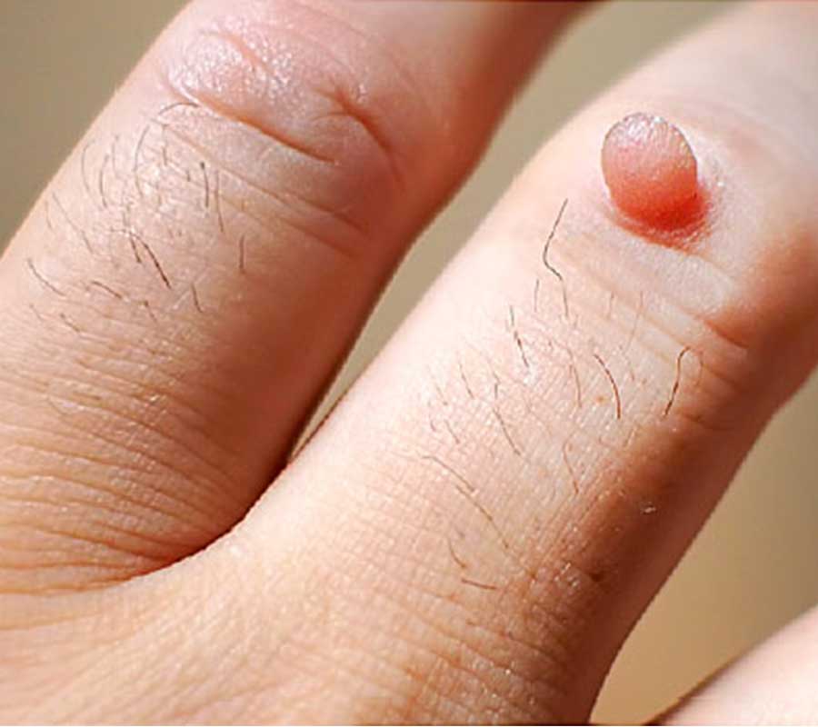 Warts treatment at Elite Clinic: Best Skin Treatment in Rohini, Delhi