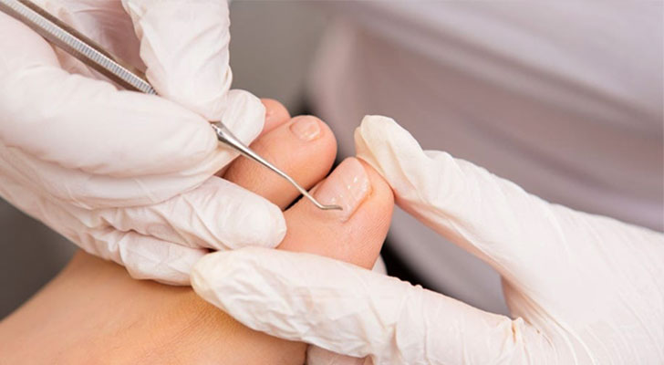 Nail Surgery: Elite Clinic Nail Surgery treatment at Elite Clinic: Best Dermatologist in Rohini, Delhi