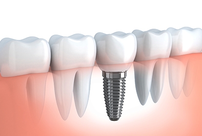 Implant Dentistry Surgery at Elite Clinic: Dental Implant Clinic in Rohini, Delhi | Dental Implant in Rohini,Delhi | Best Implant Dentist in Rohini, Delhi