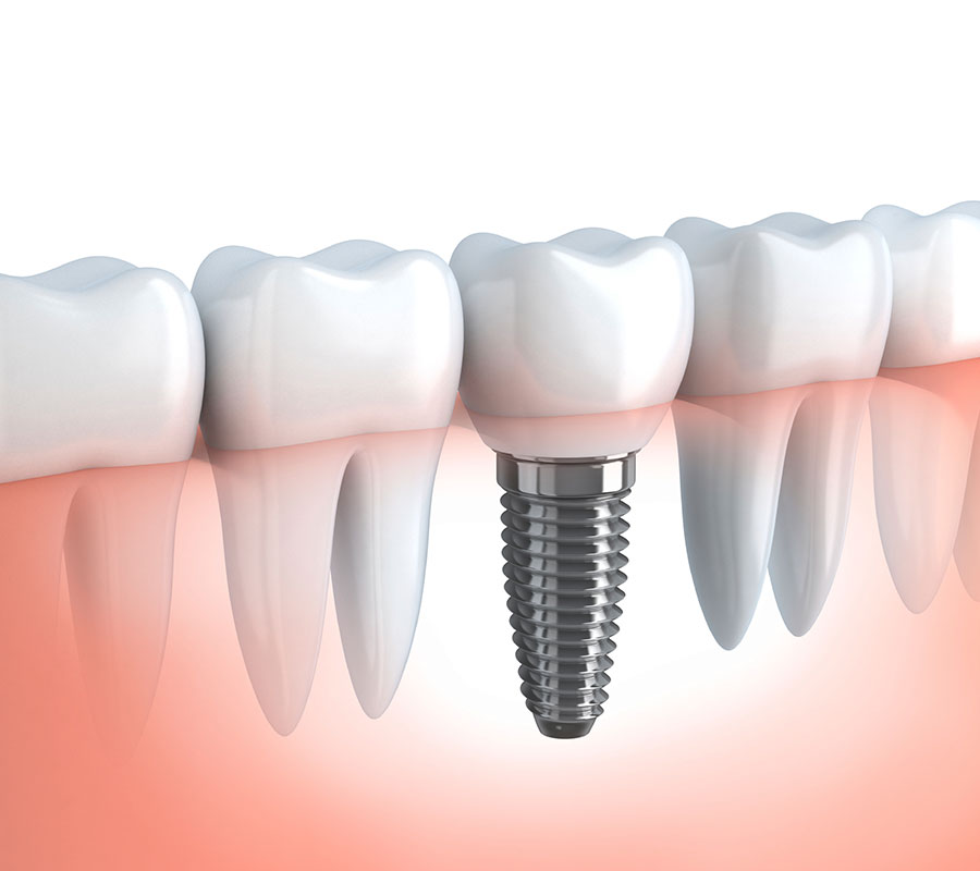 Implant Dentistry at Elite Clinc: Dental Implant in Rohini, Delhi