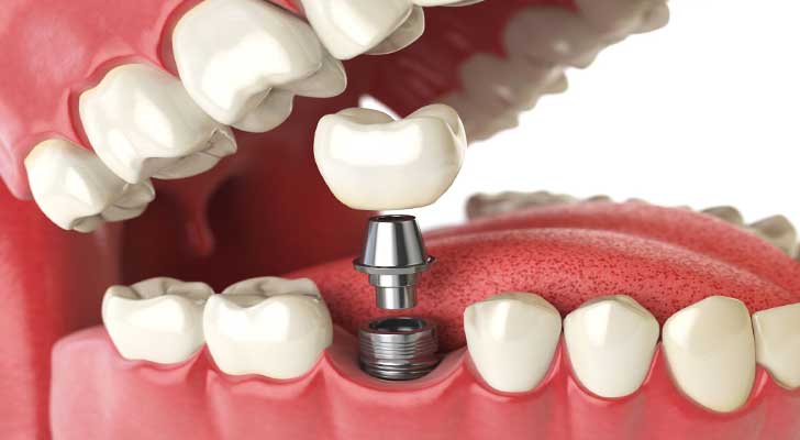 Elite Clinic: Dental Implant in Rohini, Delhi