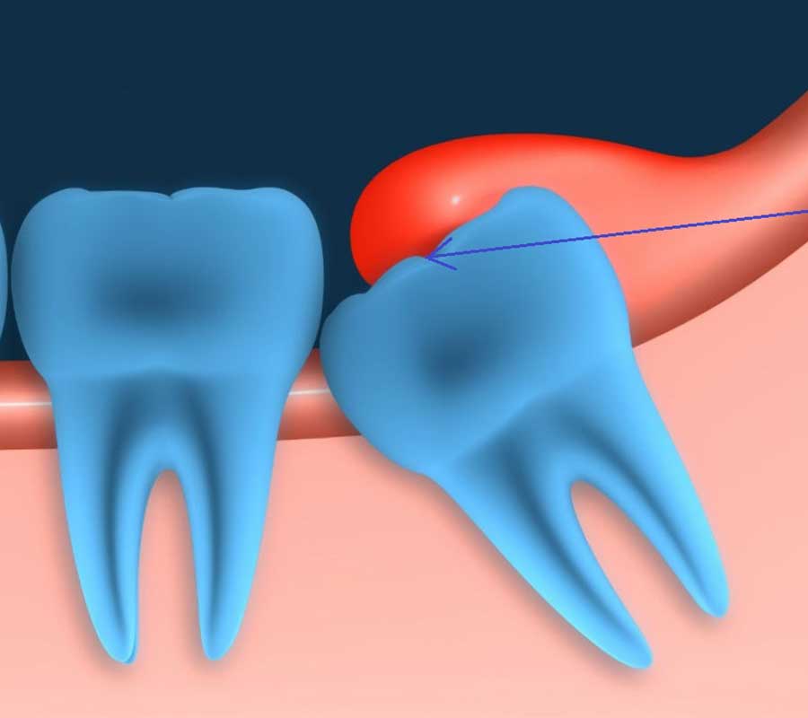 Impacted Tooth treatment at Elite Clinic: best dentist in rohini | best dentist in delhi
