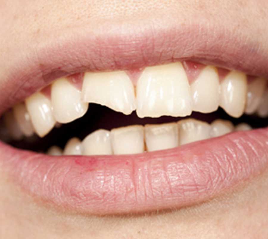 Chipped Tooth treatment at Elite Clinic: dentist in rohini | dentist in delhi